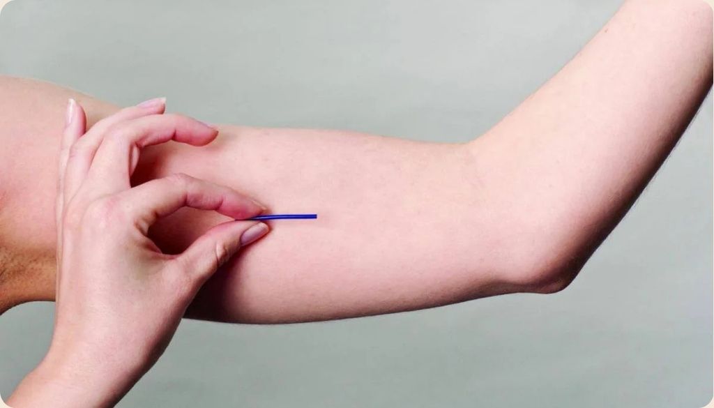 Contraceptivo Implanon passa a ser obrigatório em planos de saúde hoje&nbsp;(01)