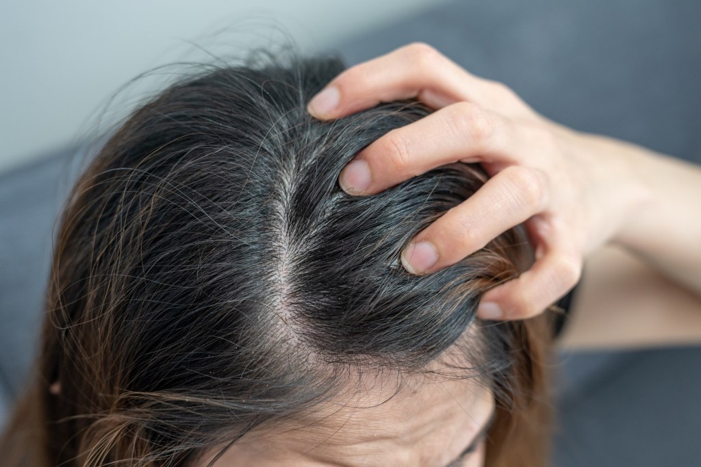 Dermatologista aponta métodos eficazes que ajudam a eliminar a&nbsp;caspa