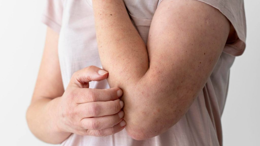 Brasil registra mais de 22 mil novos casos de hanseníase; doença tem cura pelo&nbsp;SUS