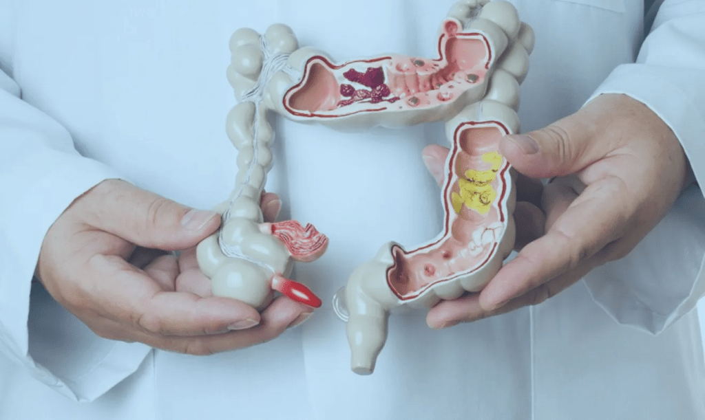 SUS adota novo exame para detectar câncer de intestino antes dos sintomas